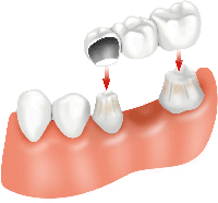dental bridge - fitting
