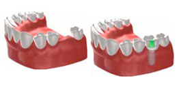 single tooth implant