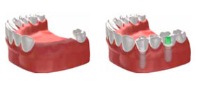 several tooth implants