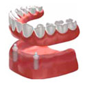 Removable dentures