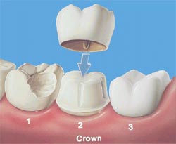 Porecelain crown